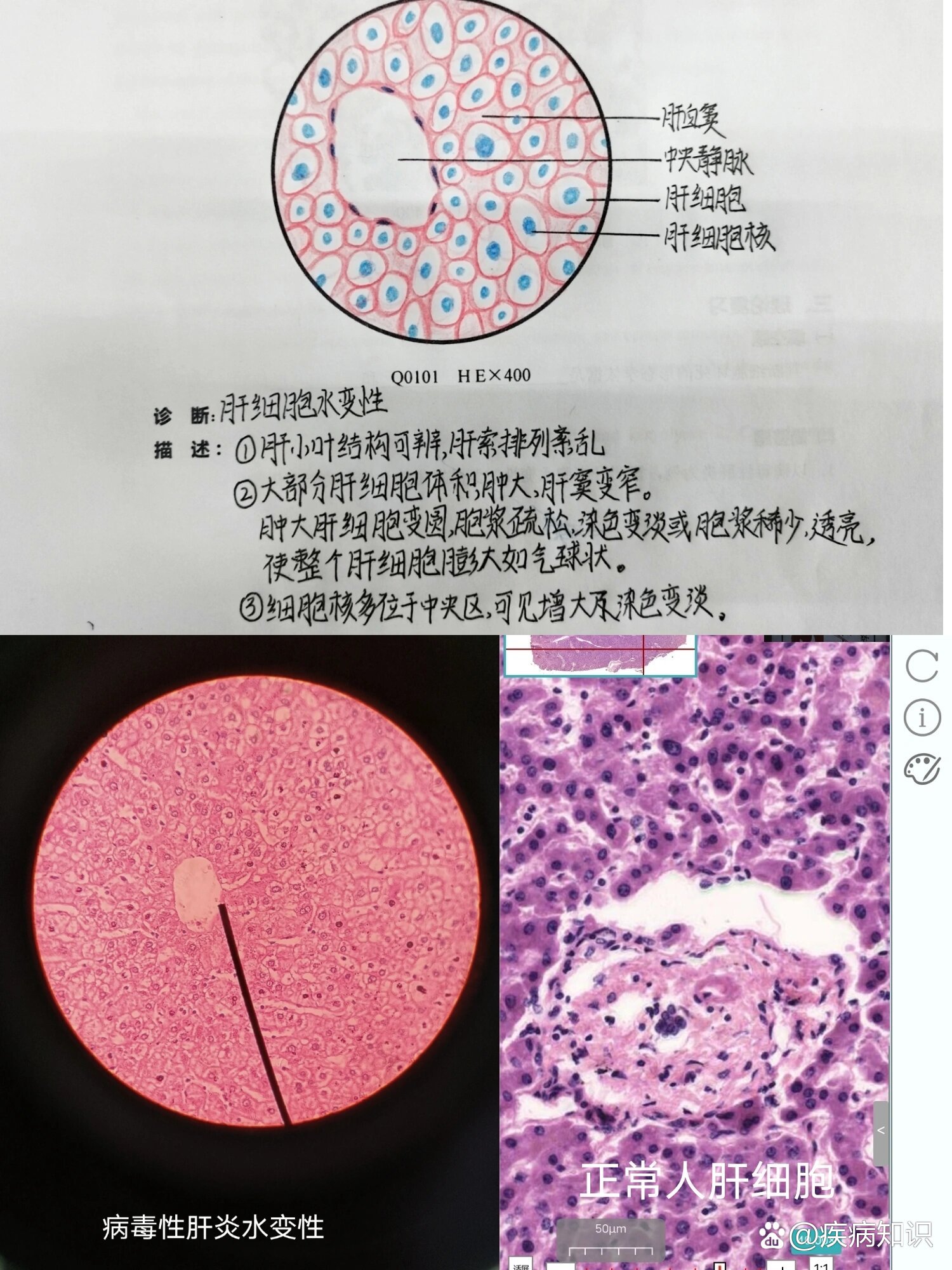 肝细胞水肿——红蓝铅笔手绘图