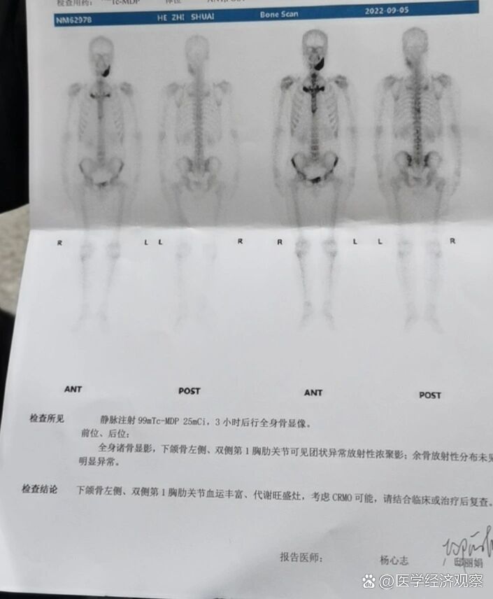骨扫描结果