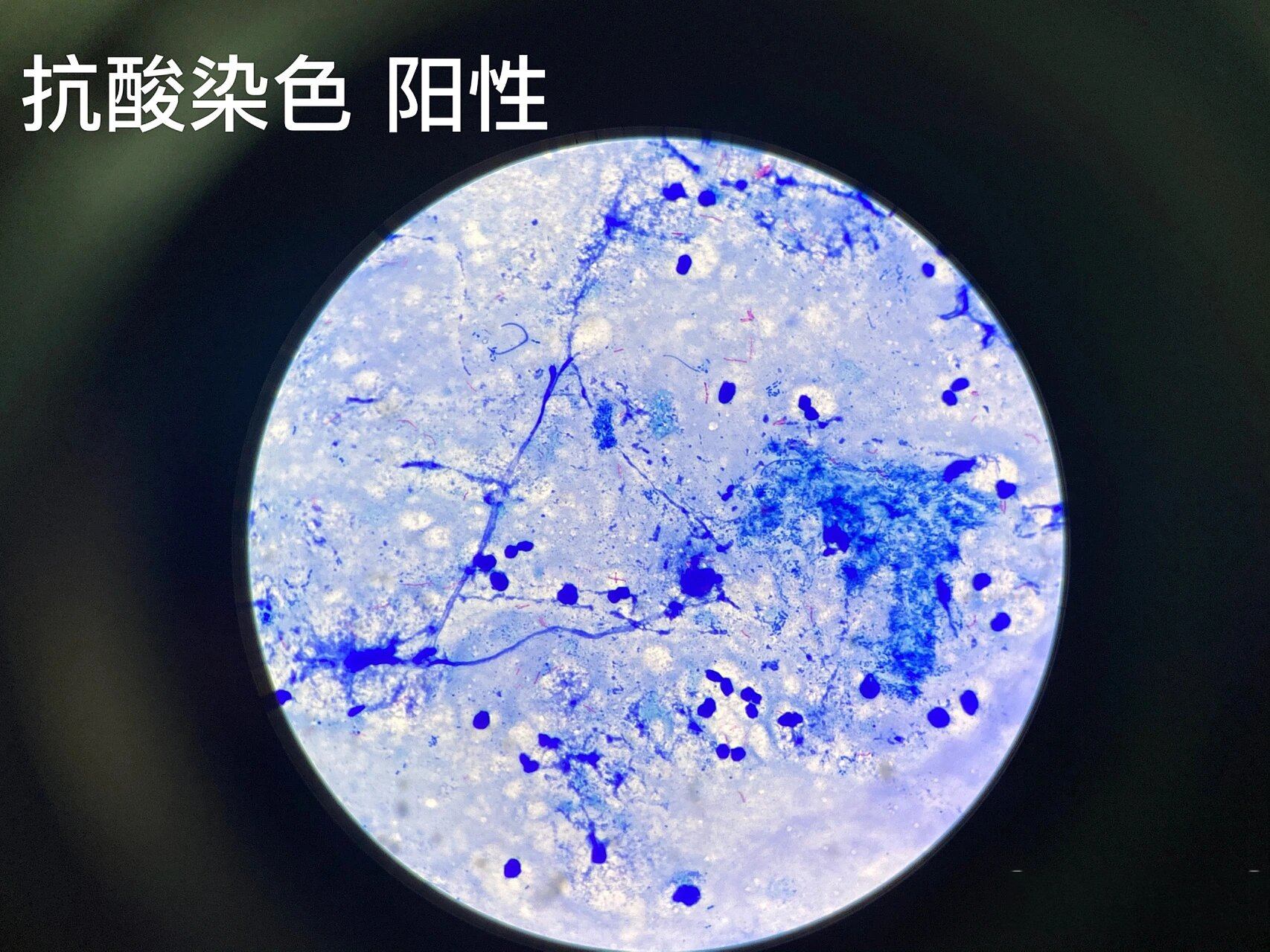 抗酸杆菌(抗酸染色