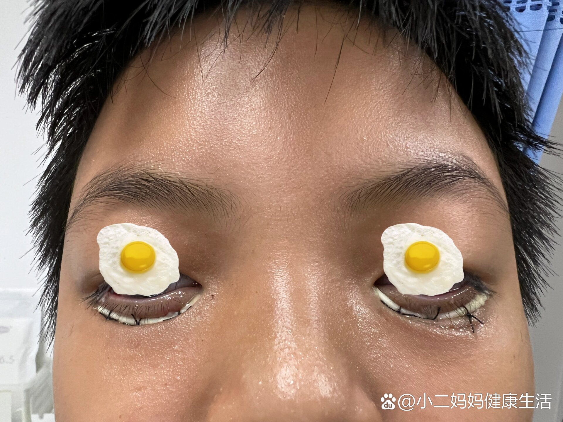 睫毛长倒了,老是戳到眼球怎么办?