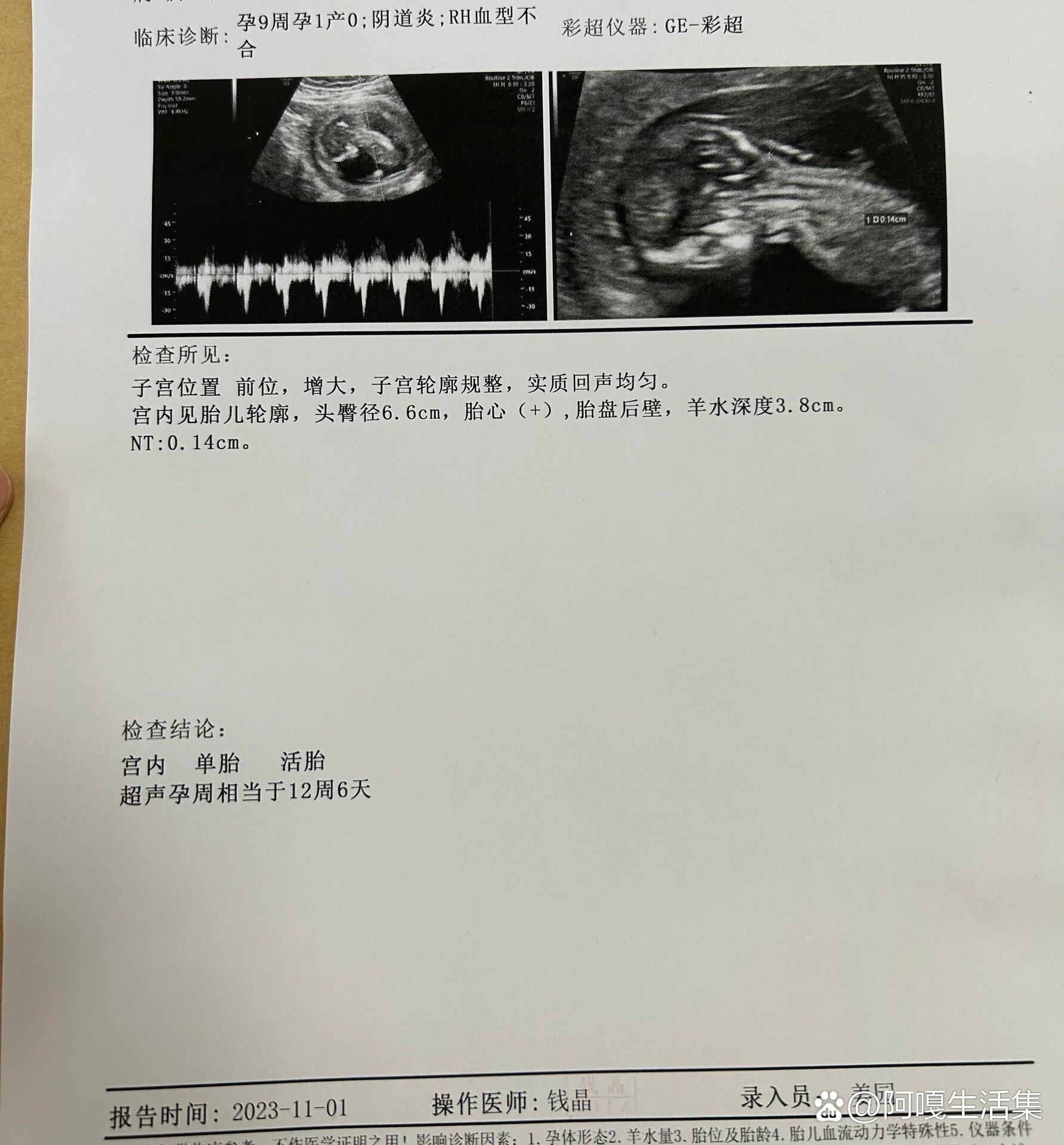 br孕检nt是通过b超手段测量胎儿颈项部皮下无回声透明层最厚的部位