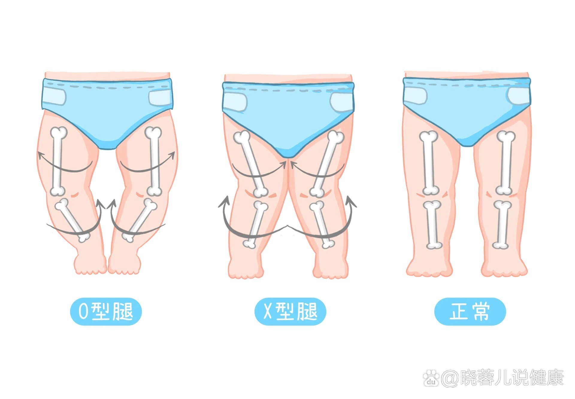 4岁宝宝x型腿照片图片