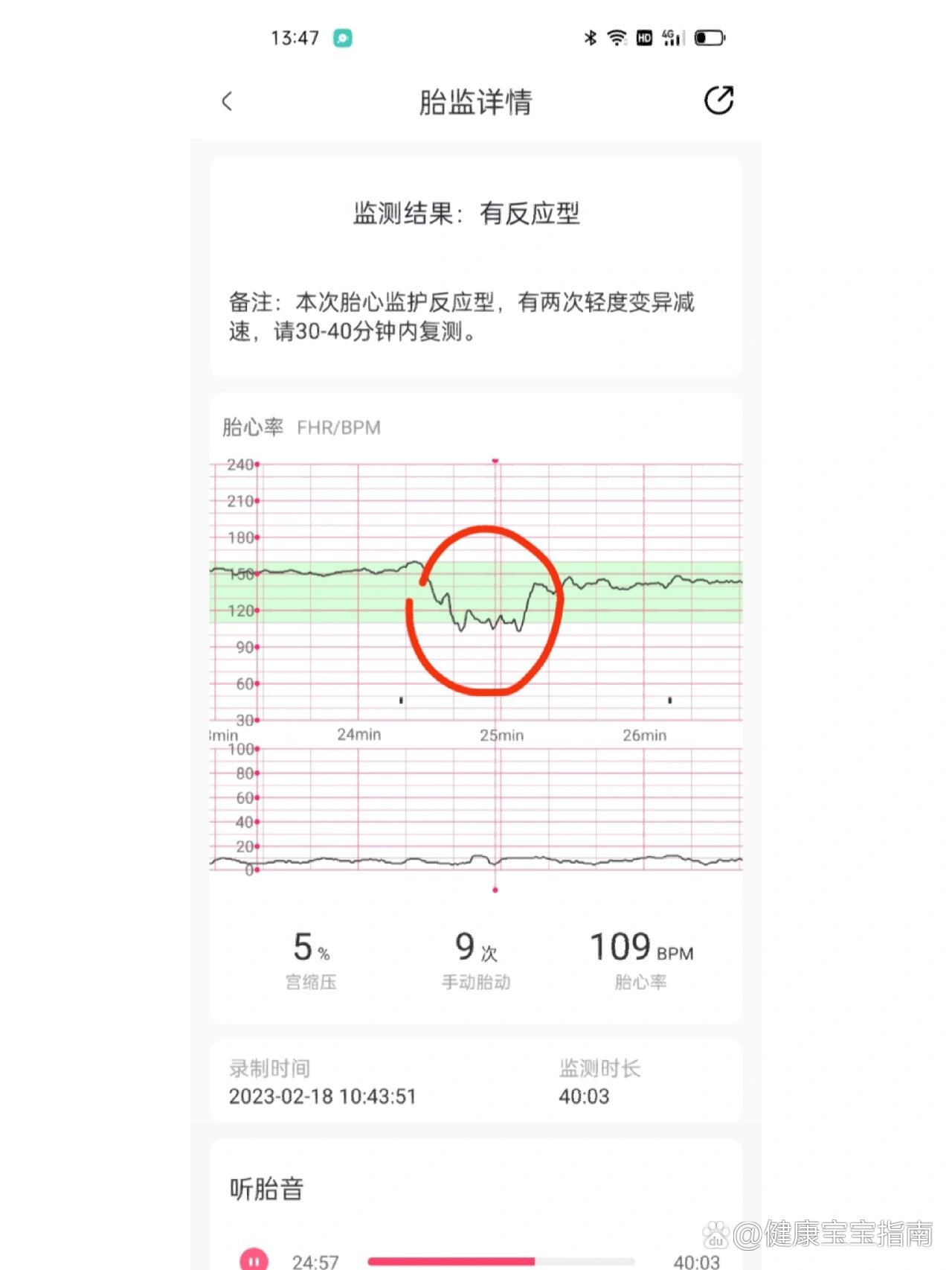胎心检测变异减速