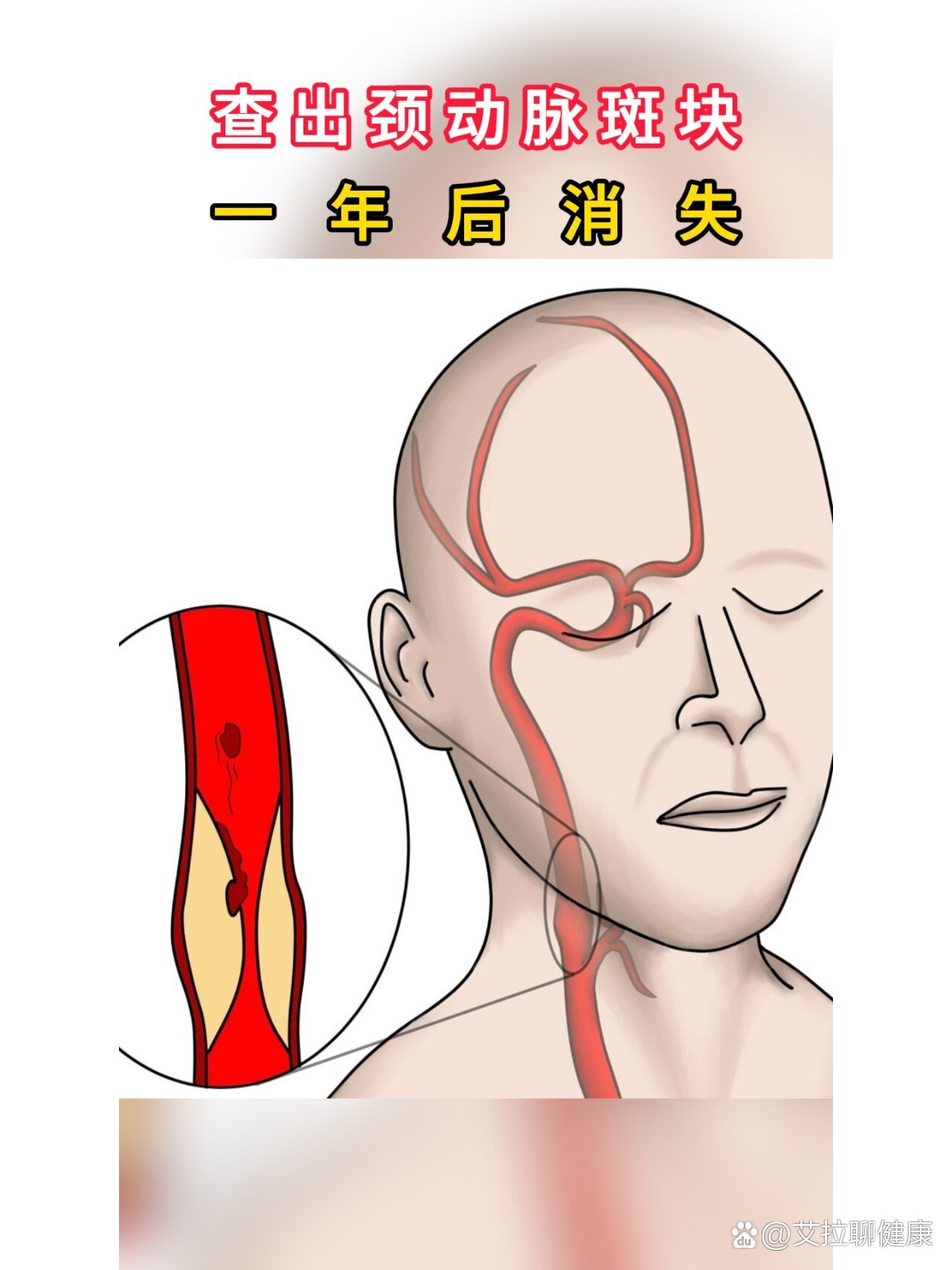 左侧颈动脉斑块形成图片