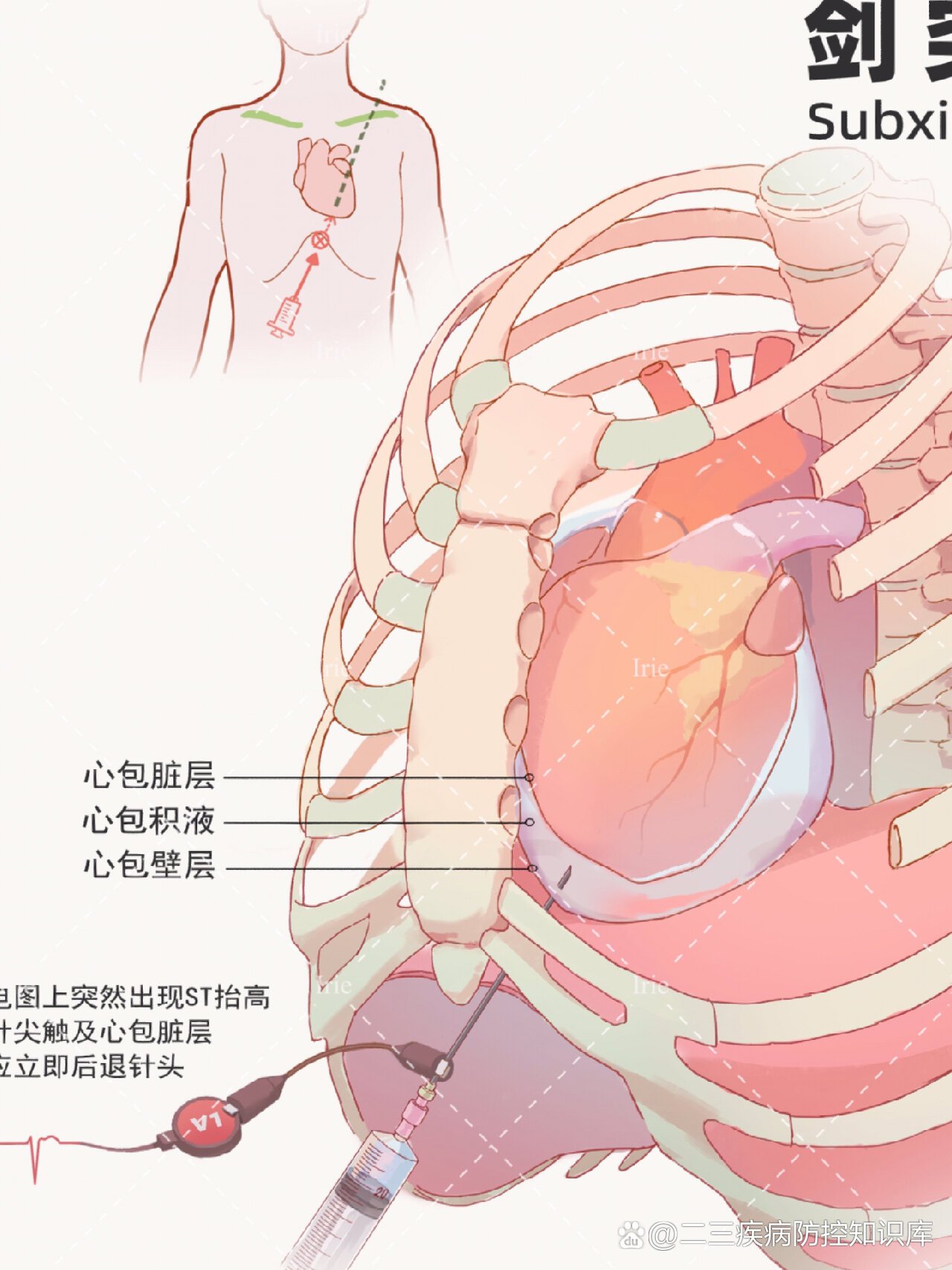 胸腔穿刺点定位图图片