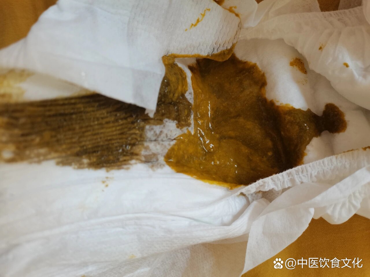 宝宝喝了豉翘清热颗粒拉稀便黑色