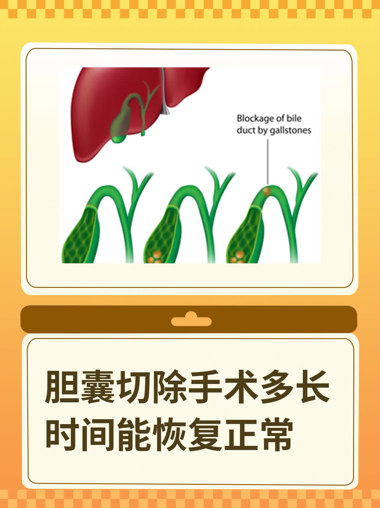 为什么要切除胆囊要取出来吗为什么在线