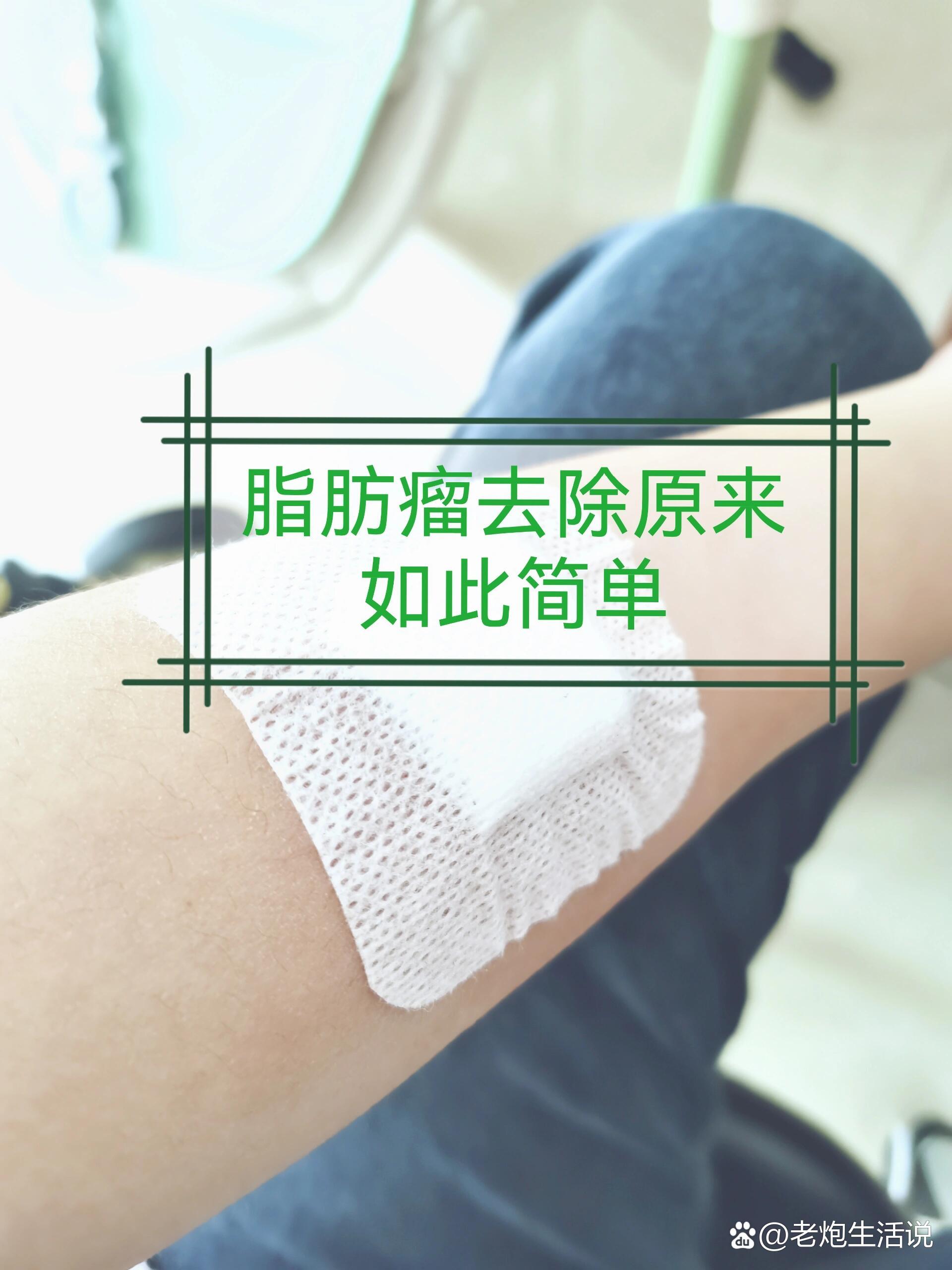 脂肪瘤去除原来如此简单