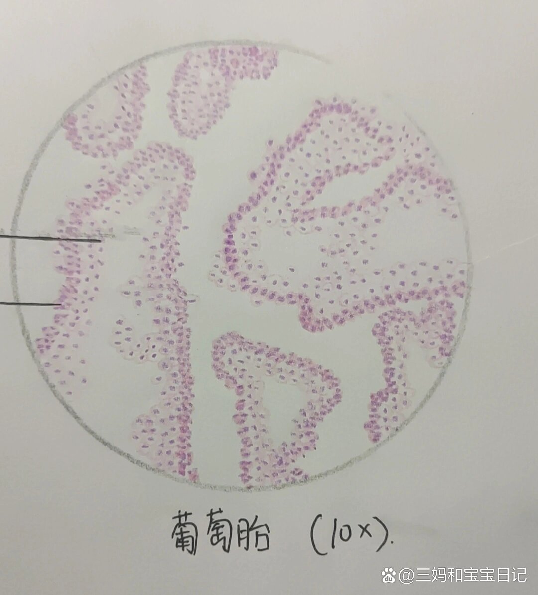 葡萄胎切片绘图图片