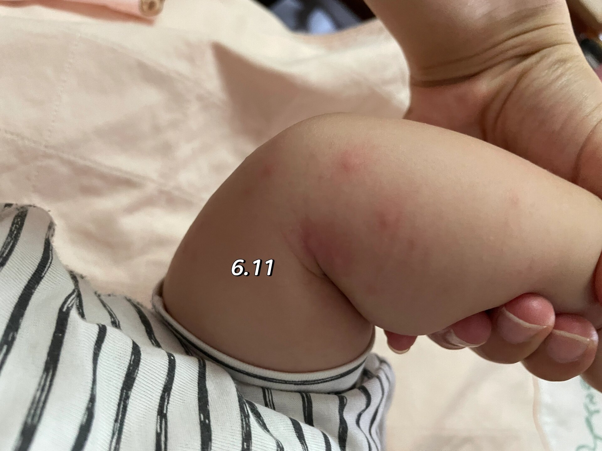 四个半月婴儿红疹宝宝起红疹已经快两周了每天看到