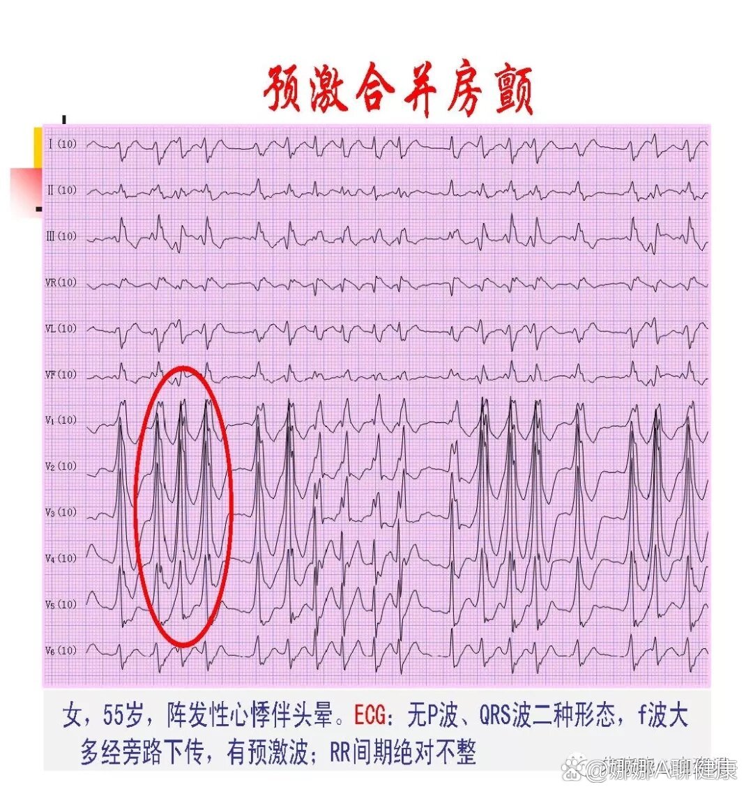 阵发性心房颤动图片