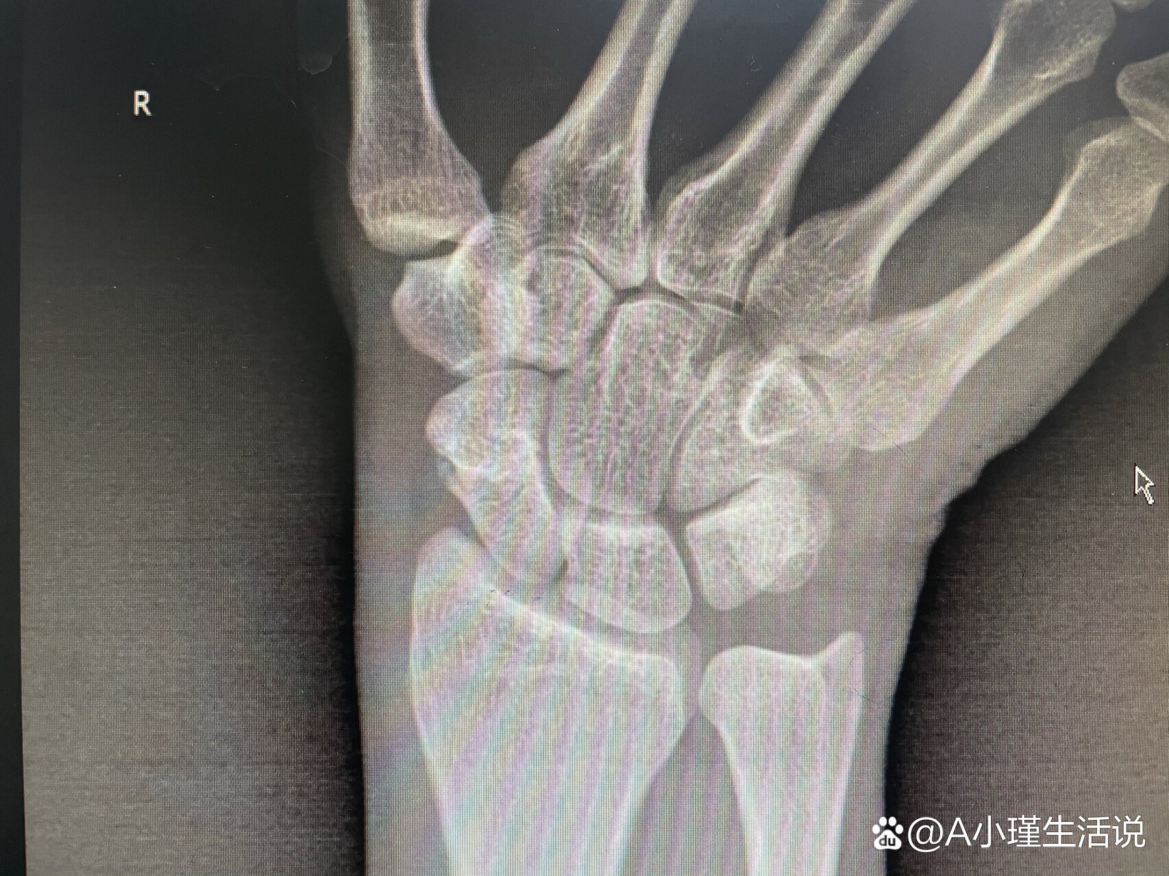 右手舟状骨骨折