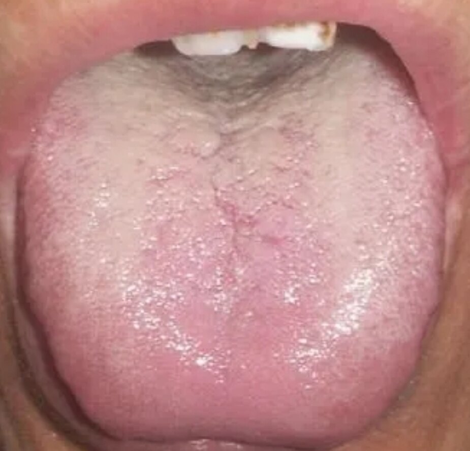 老中医看舌诊:教你根据不同的舌头部位,看脏器都出了哪些问题?