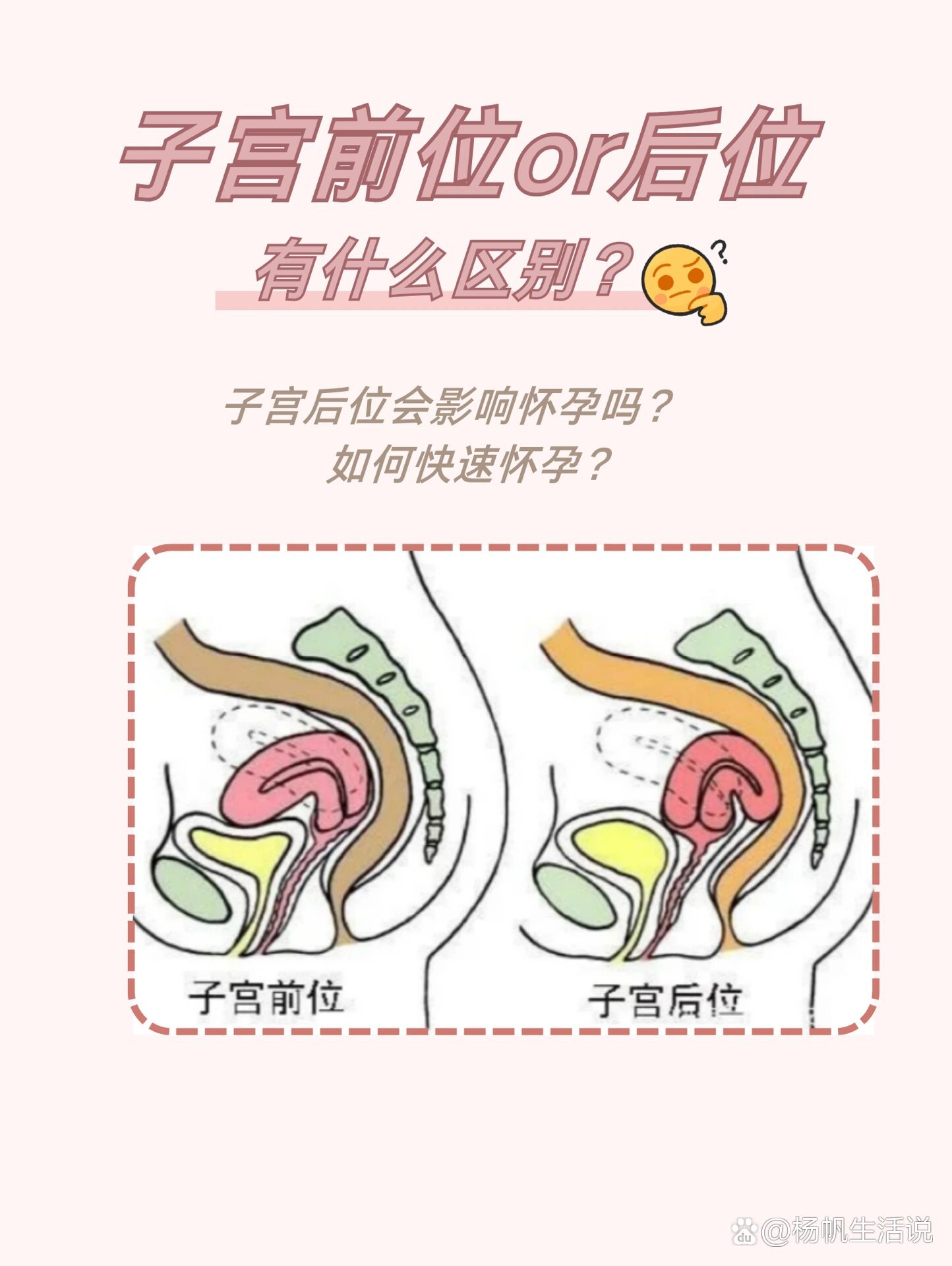 子宫前后位有什么区别939969♀15这样更好怀孕