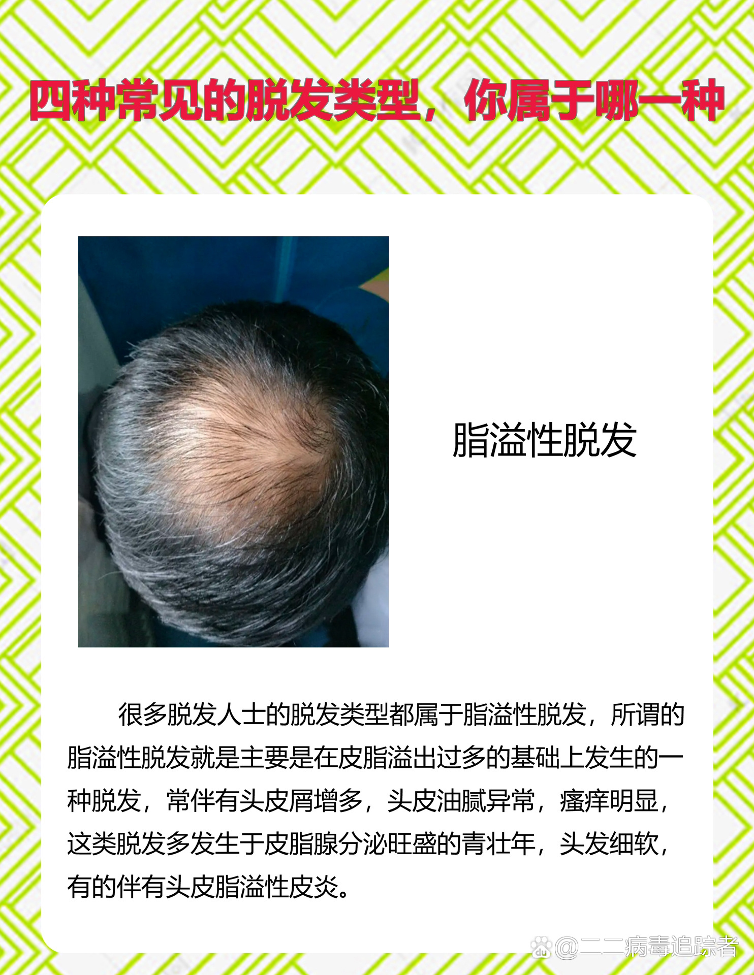 脱发常见的几种类型,你是哪一种?