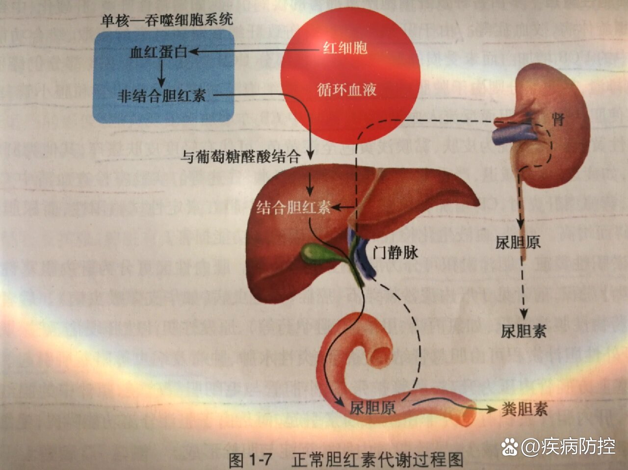 铁卟啉尿图片