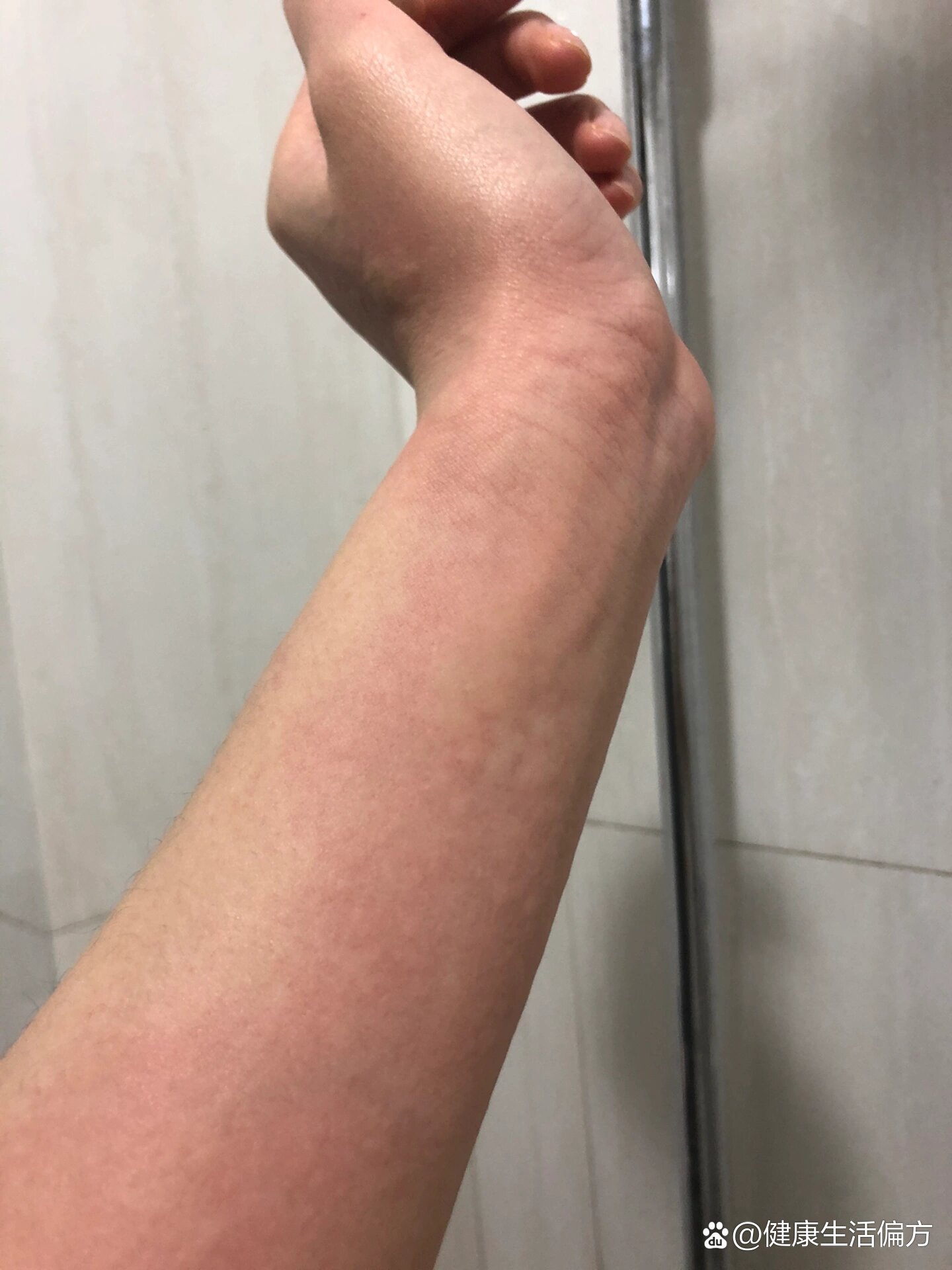 吃小龙虾过敏了