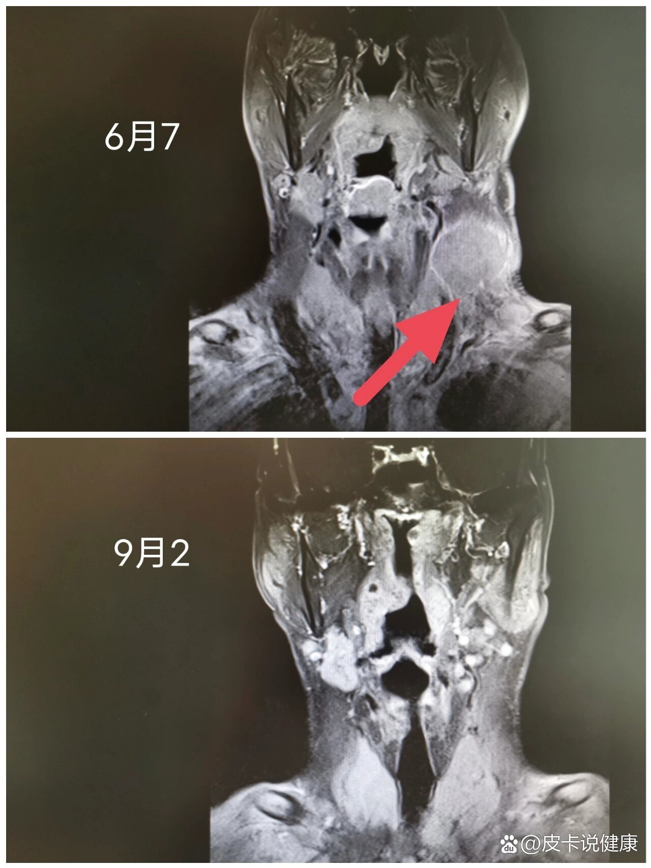 翼下颌皱襞癌图片