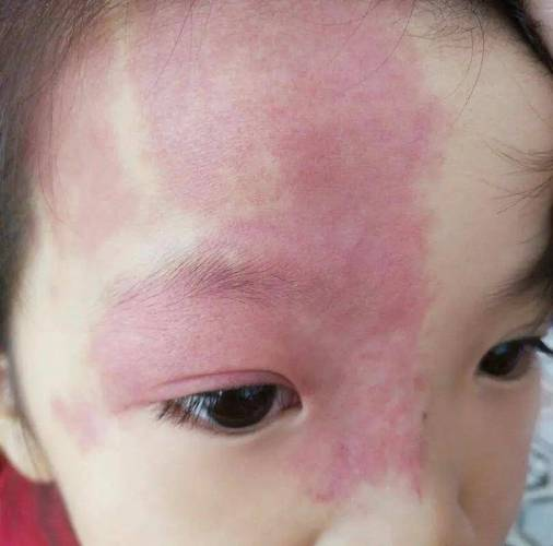 👶新生儿胎记分类大揭秘！