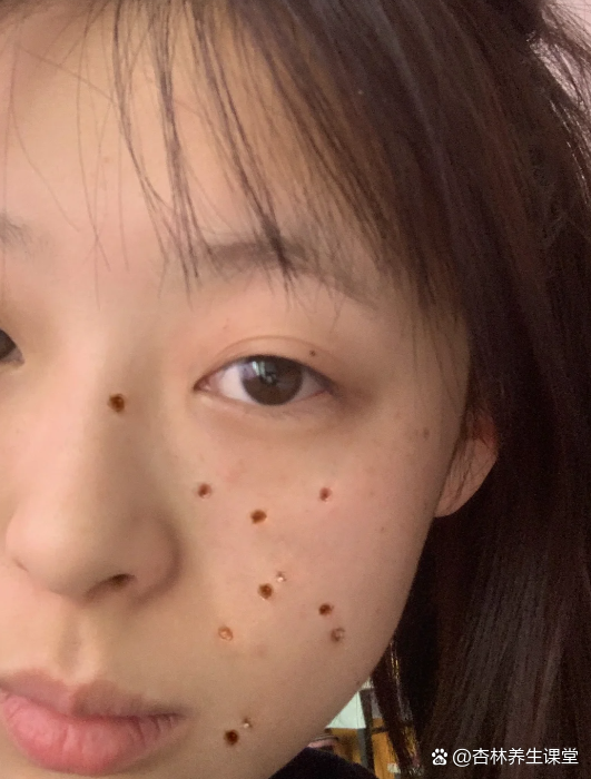 激光点痣是一种常见的痣的去除方法,它利用激光技术将痣的色素颗粒