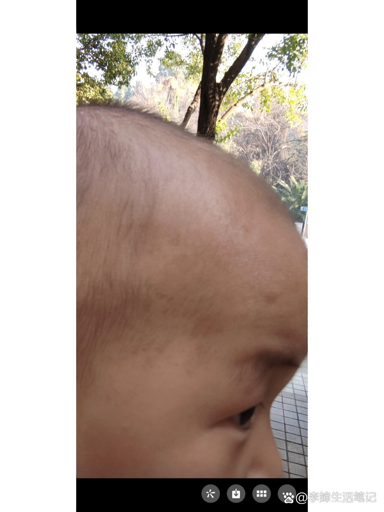 1岁宝宝太阳穴周边有褐色斑点
