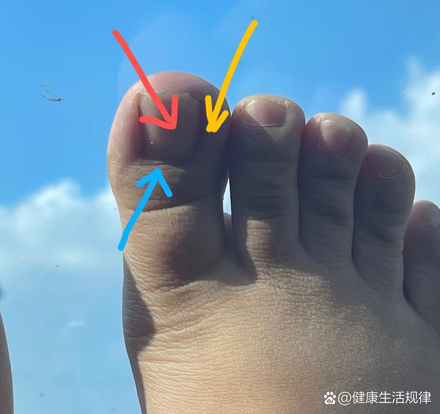 右脚大拇脚指头指甲盖及附近疼