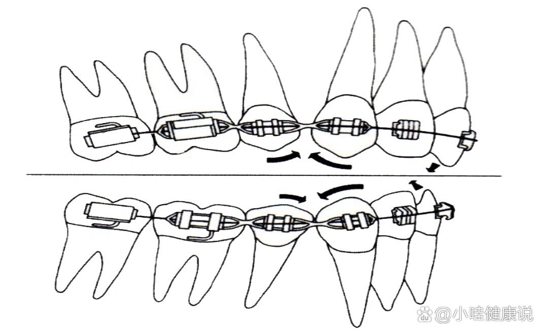 正畸垂直牵引示意图图片