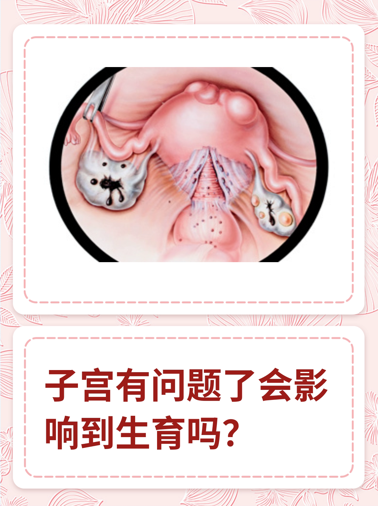 子宫有问题了会影响到生育吗