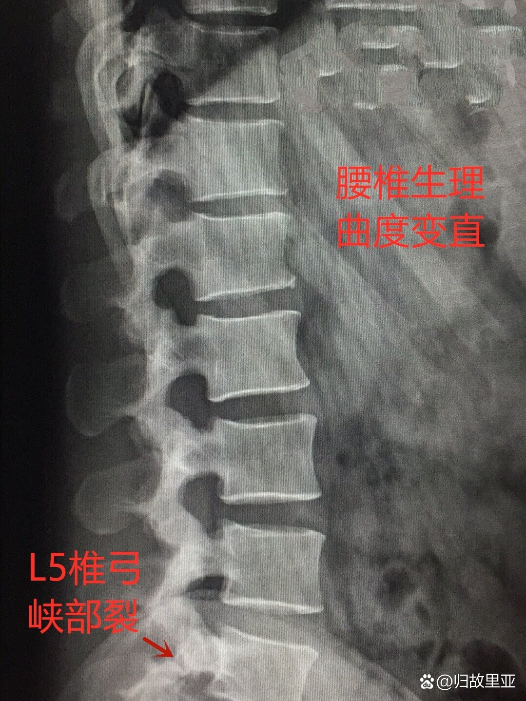 锥体和椎弓图片