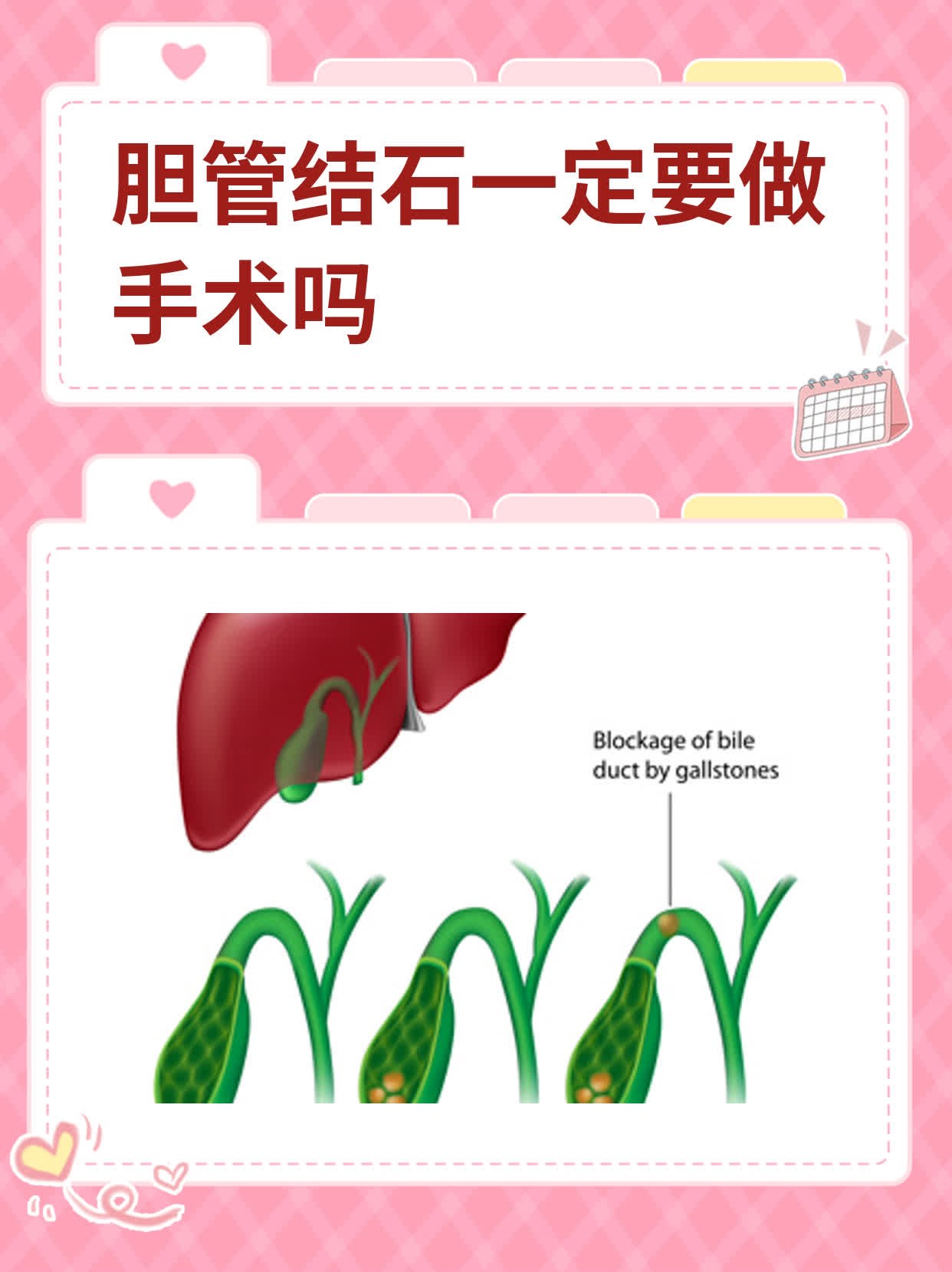 胆管结石一定要做手术吗