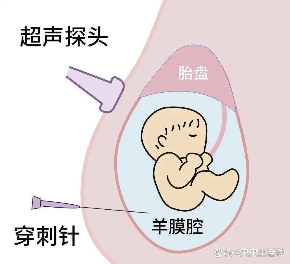 羊水门图片高清图片