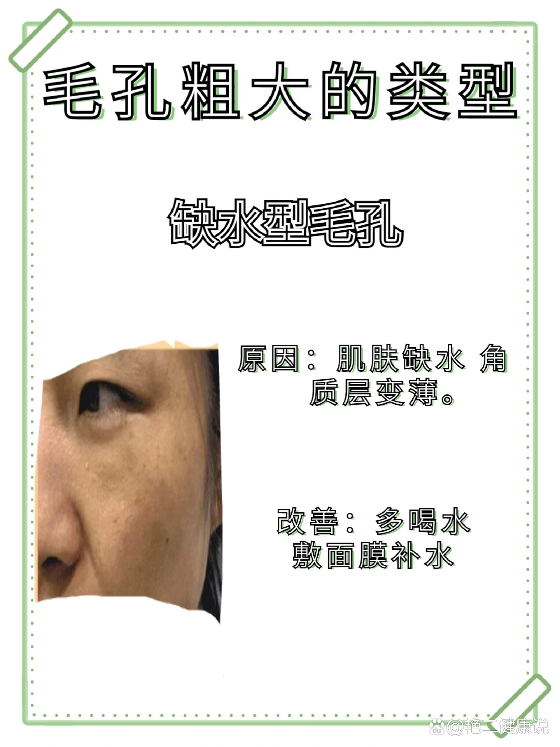 毛孔粗大的四种类型!