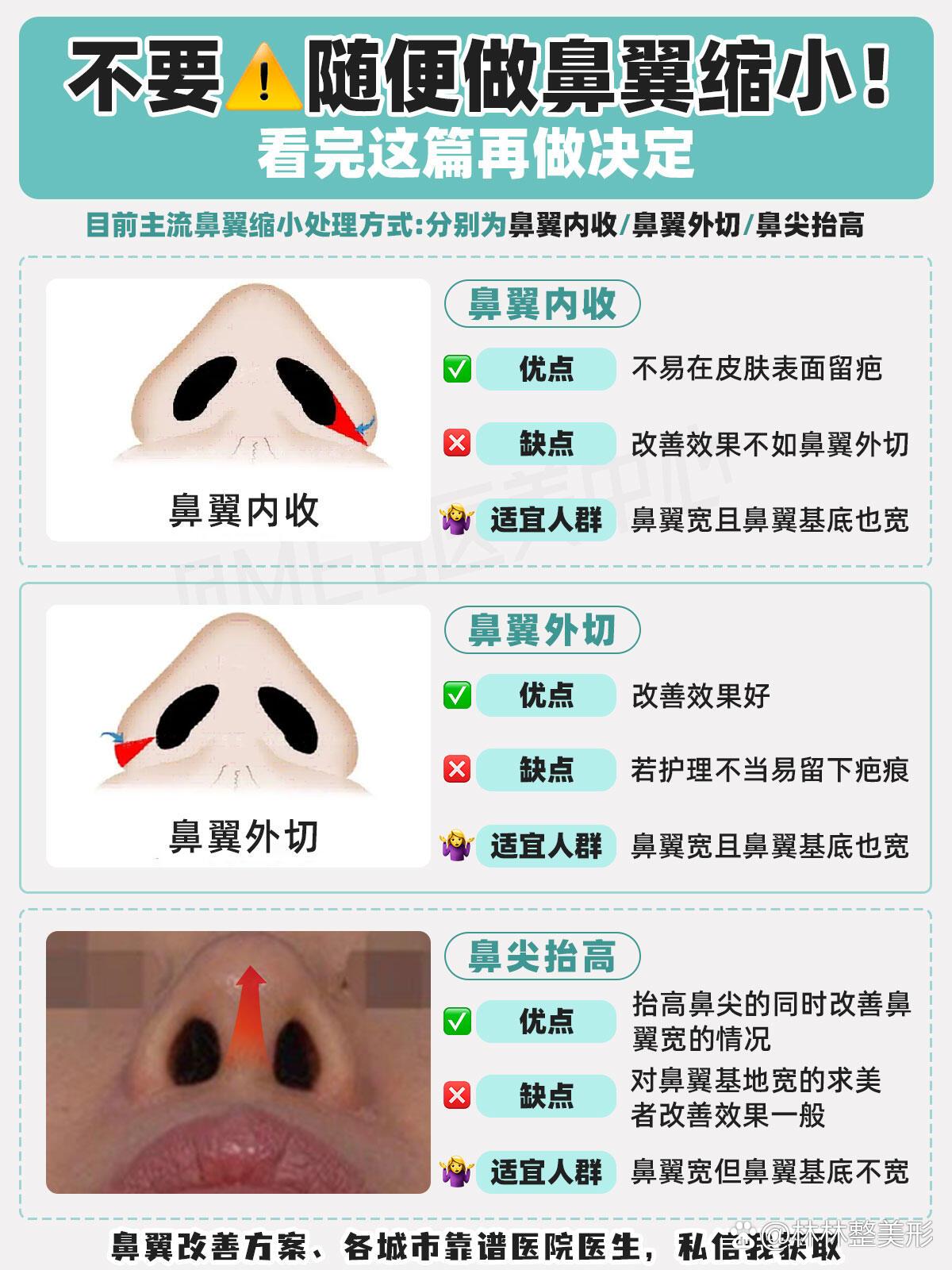 鼻翼缩小7915你真的适合做吗71do鼻攻略73