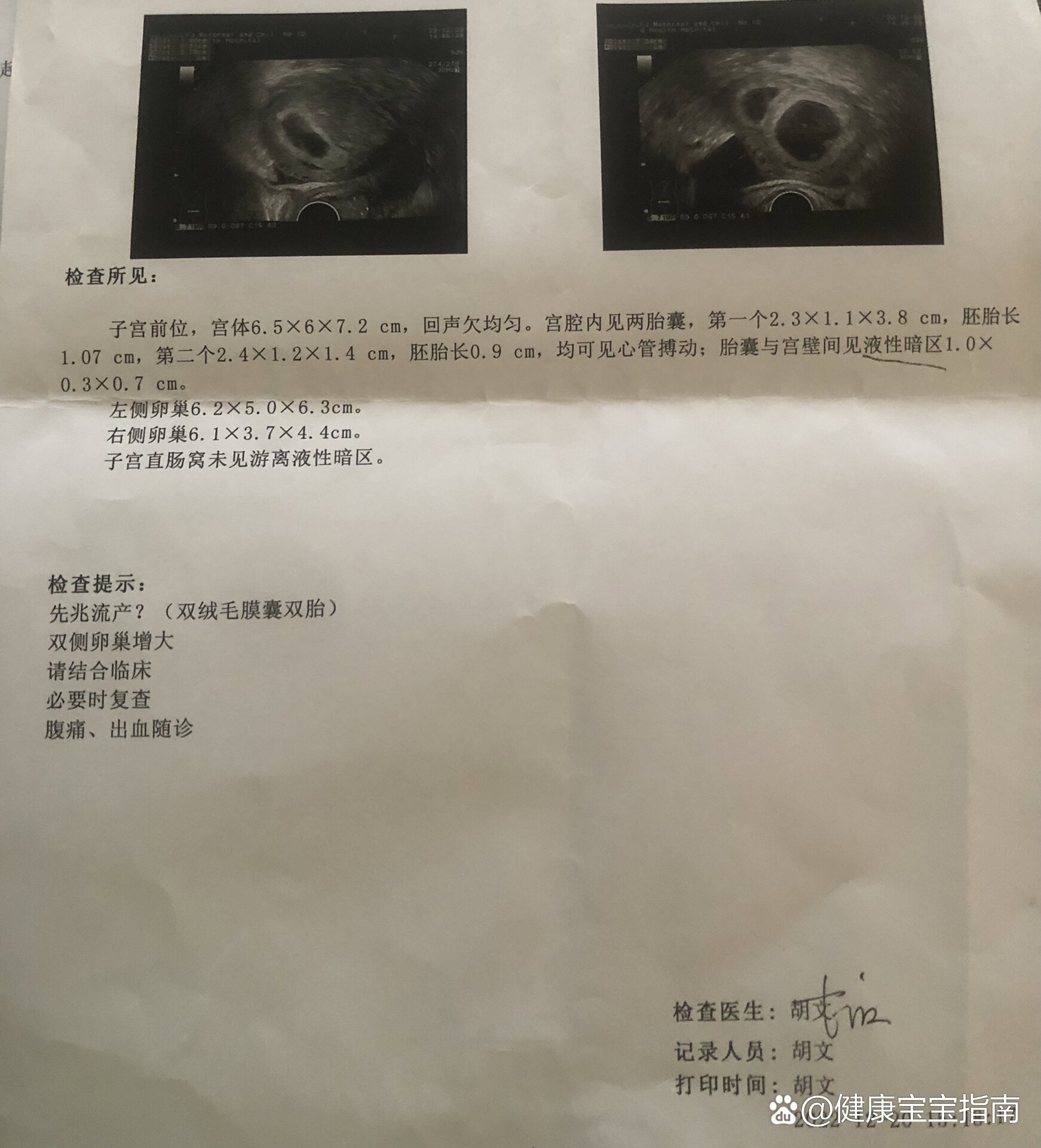 鲜胚可以移植两个吗(鲜胚可以移植两个吗多少钱)