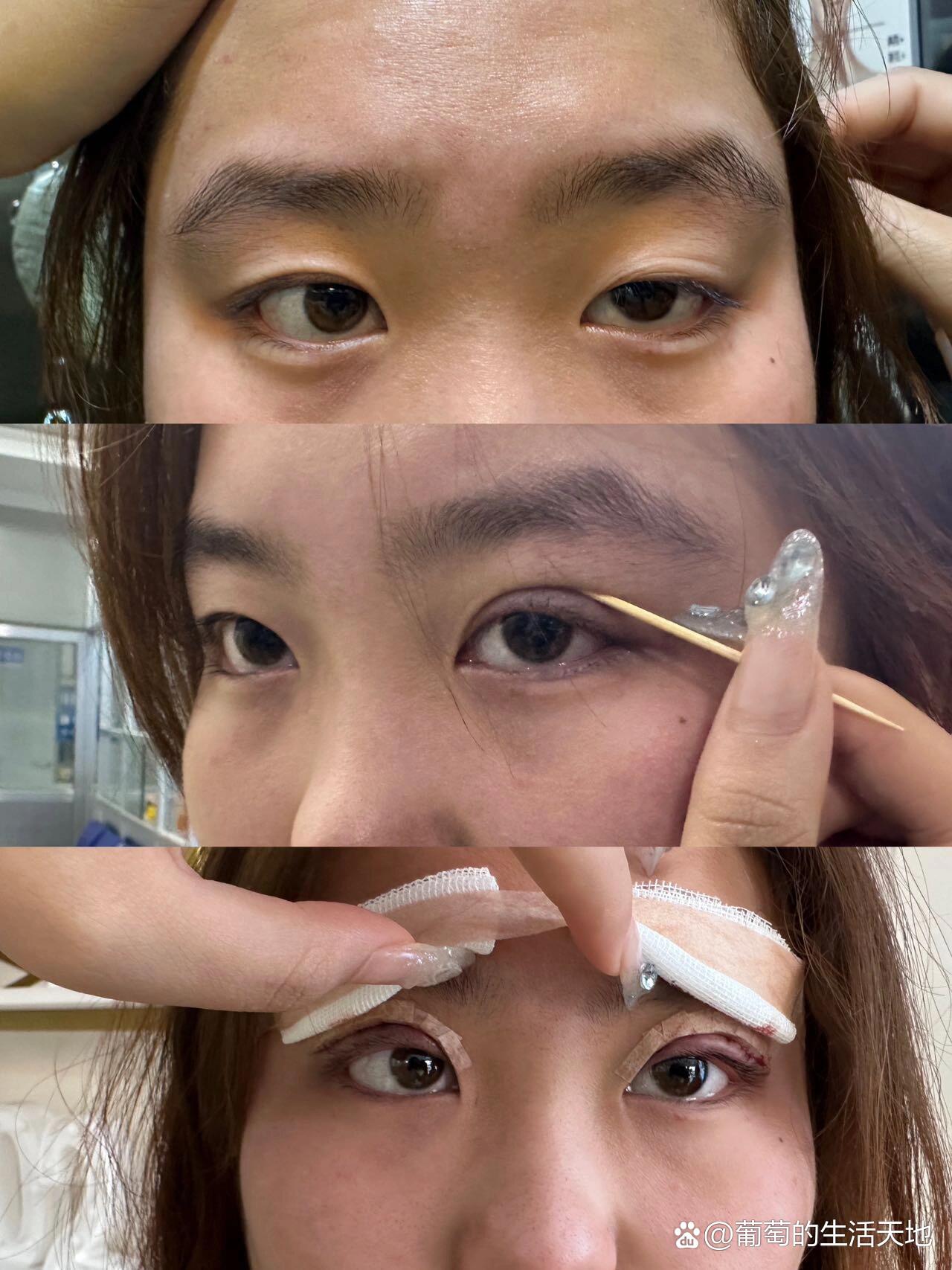 提肌无力的眼睛眼睛很多年了