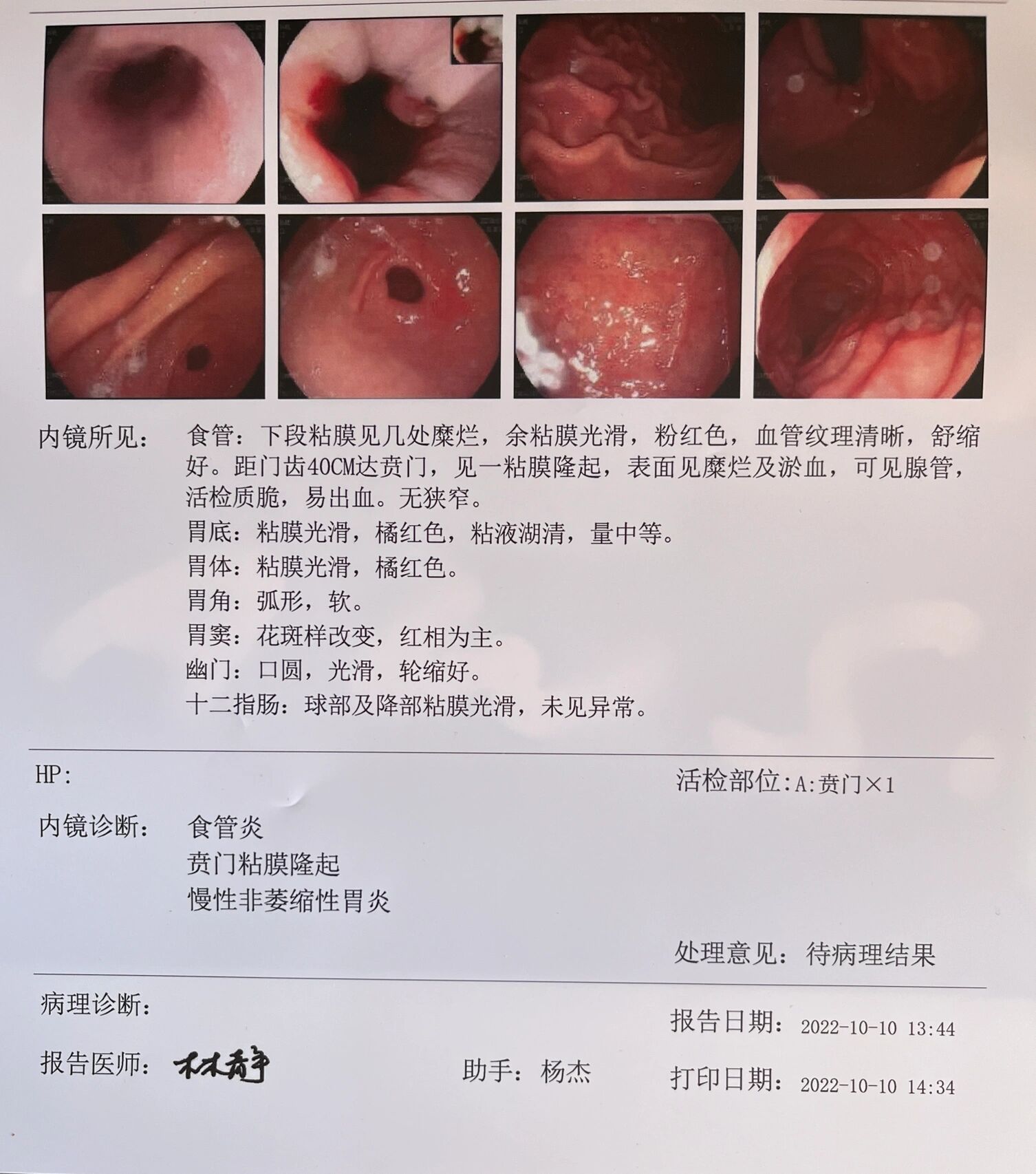 肠镜清水样便什么颜色图片