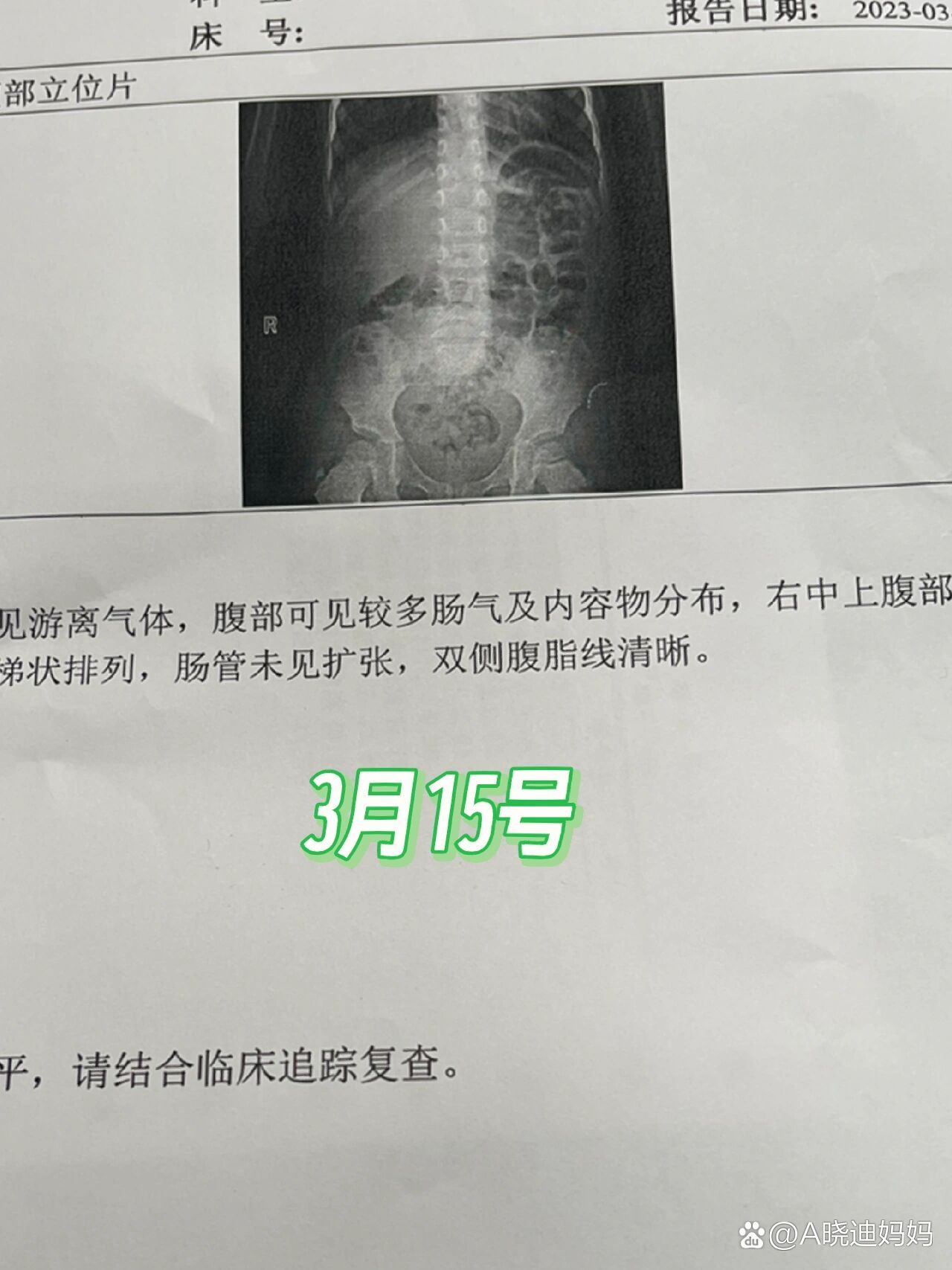 肠梗阻x线报告图片