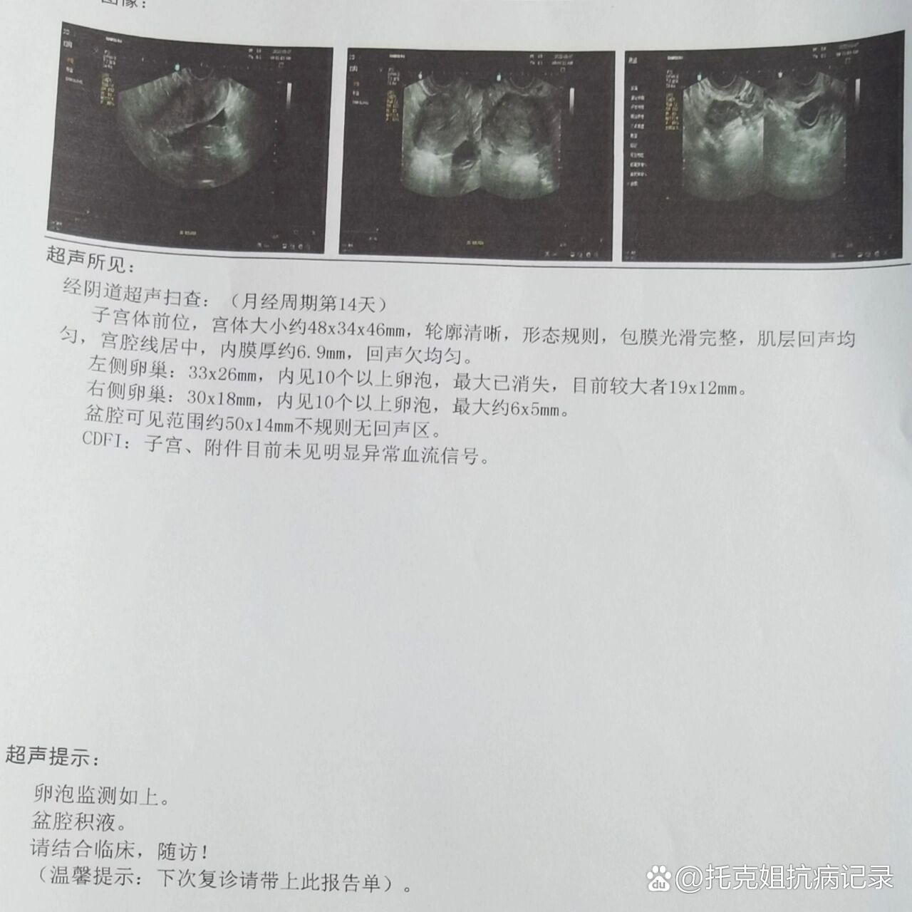 盆腔积液可以同房吗图片