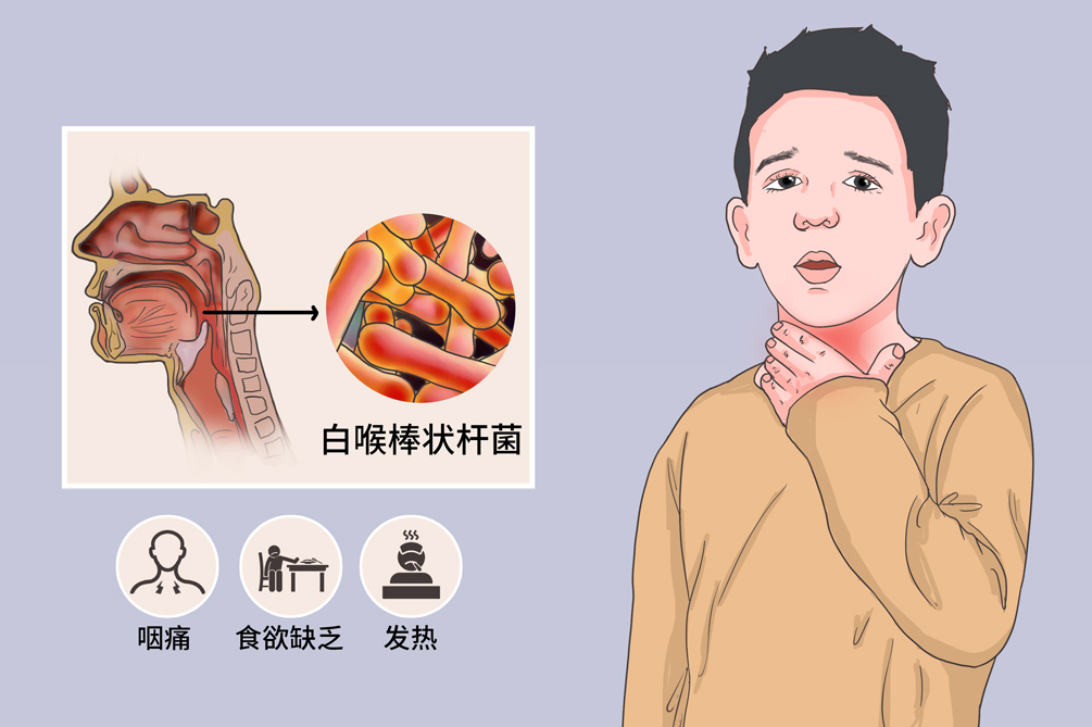 公共卫生科在预防和控制白喉中的作用