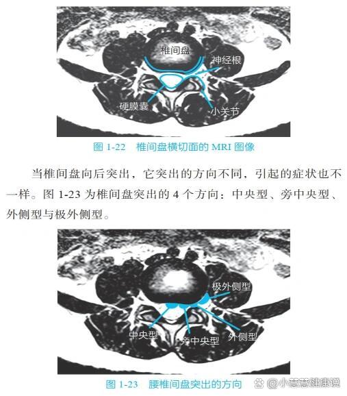 认识腰椎间盘突出mri横切面图像 /p