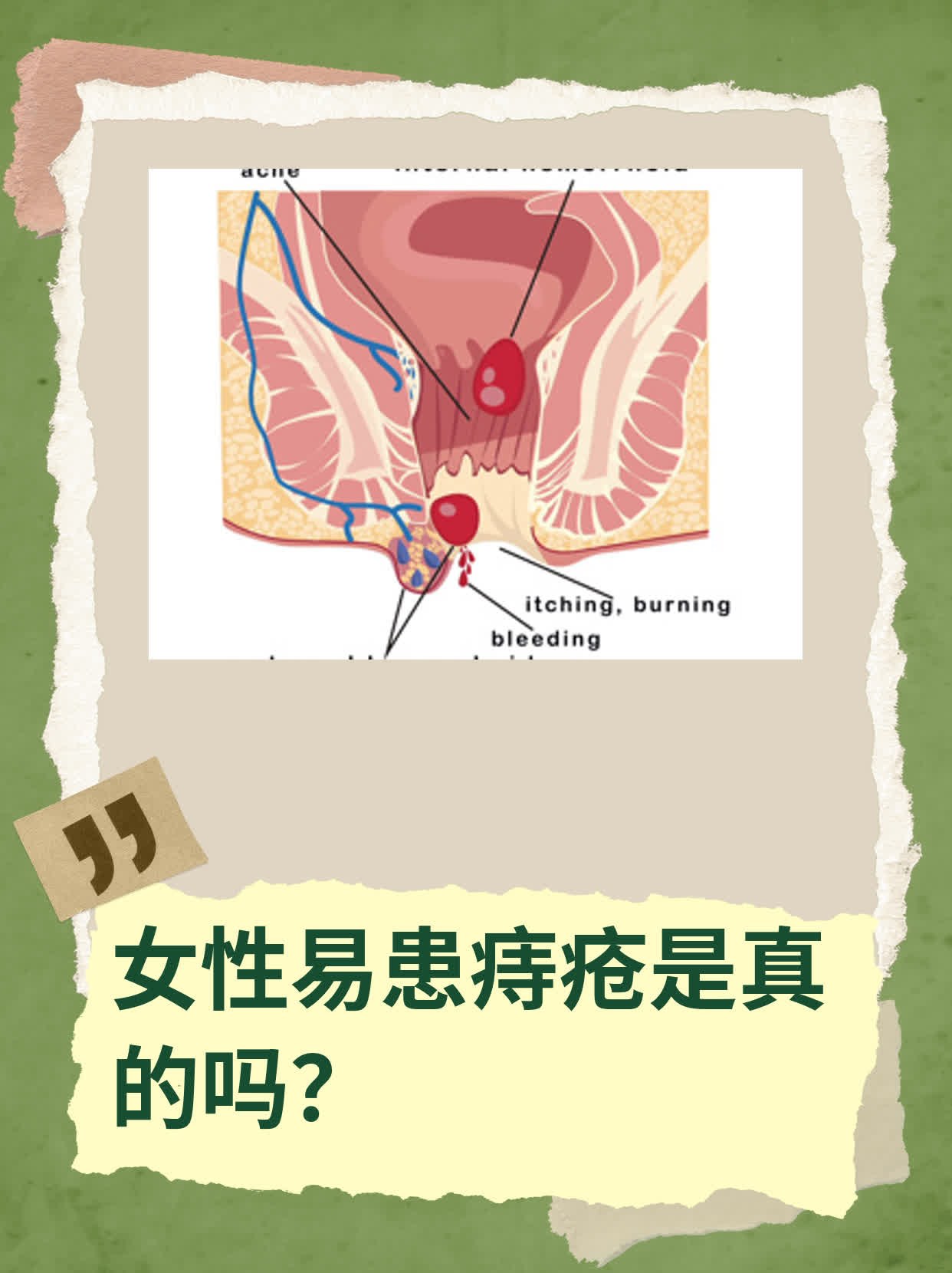 痔疮女性初期图片