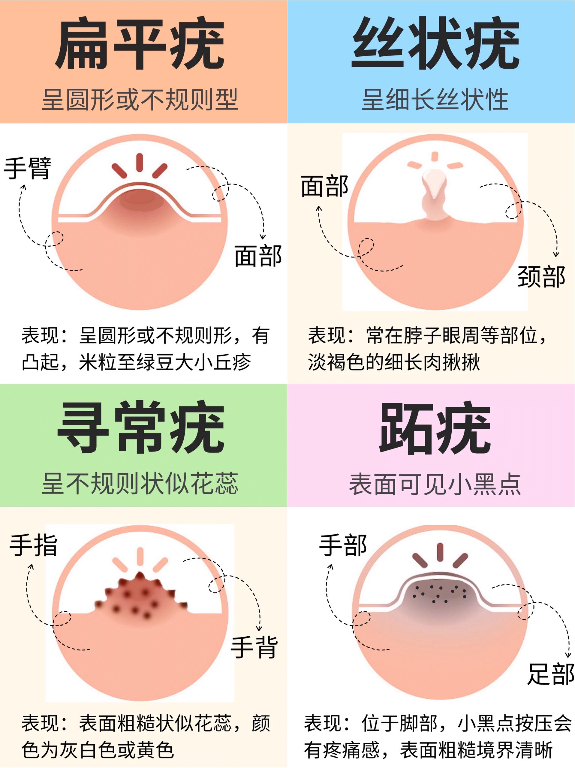 脸部扁平疣怎么治图片