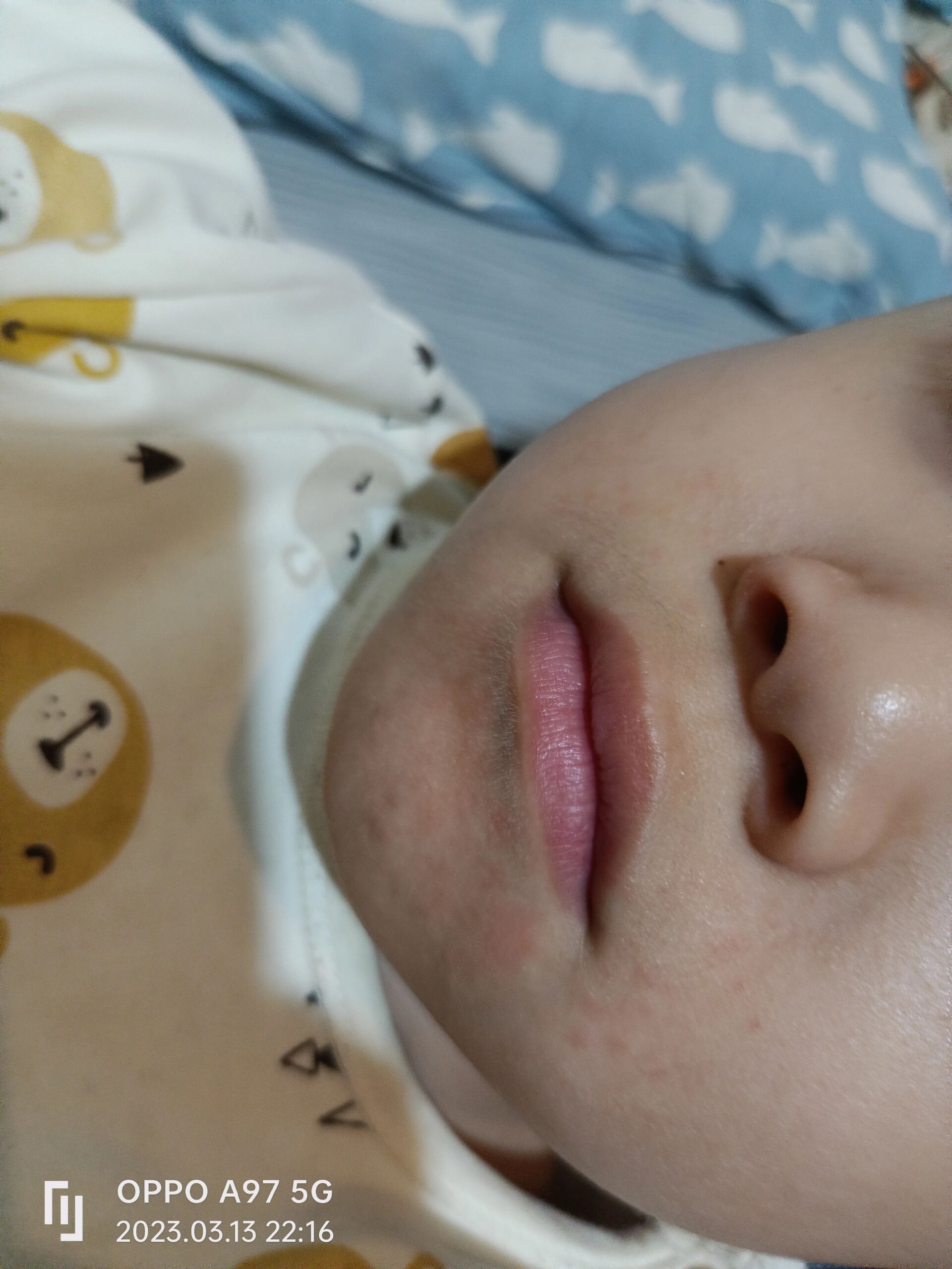 孩子下巴长了红点点