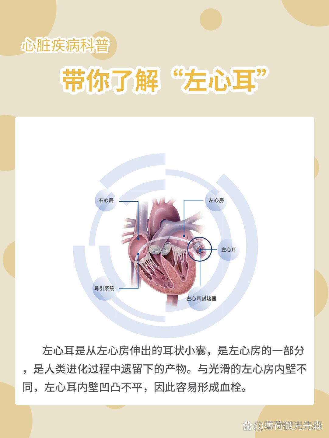 心脏疾病科普|带你了解"左心耳封堵术"