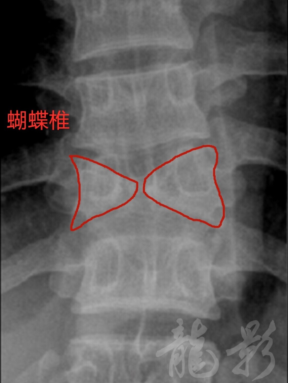 蝶骨突出图片