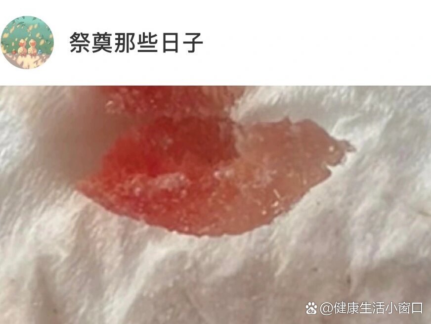 (止血明胶海绵) br>吐了一个棉球后,发现牙洞里还有棉花,请问这是可