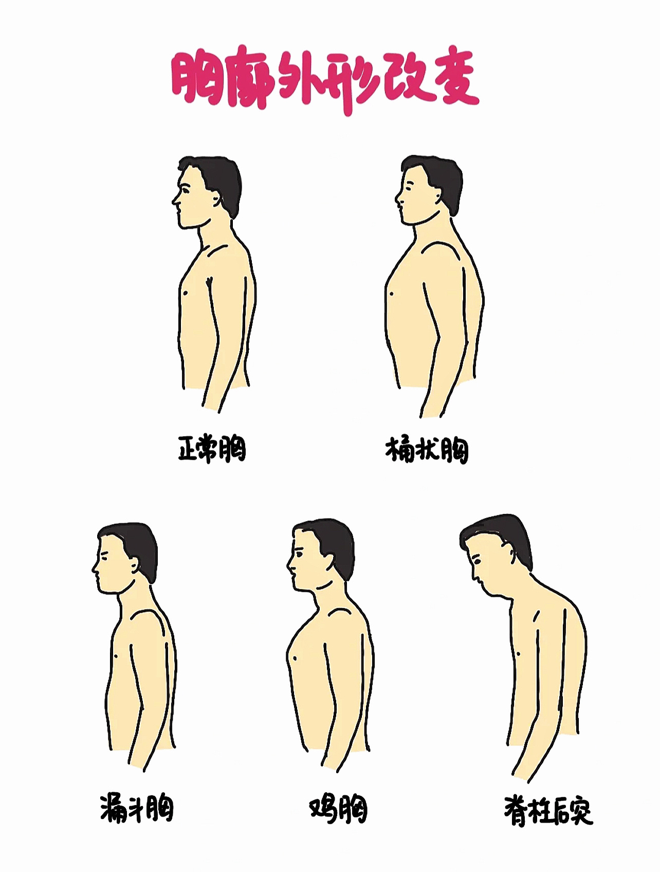 03桶状胸|不同的胸廓外形改变97