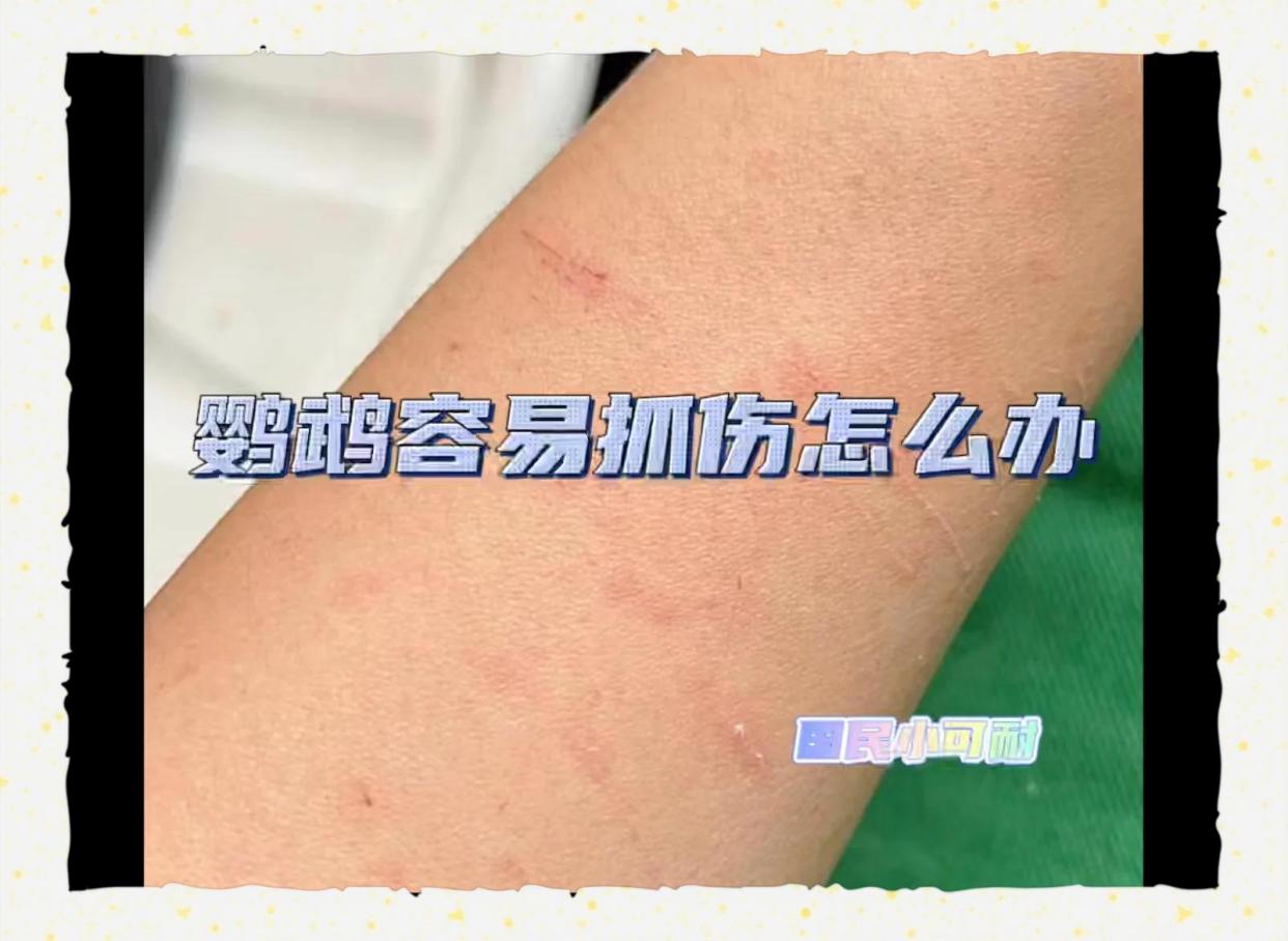 鹦鹉抓伤怎么办？
