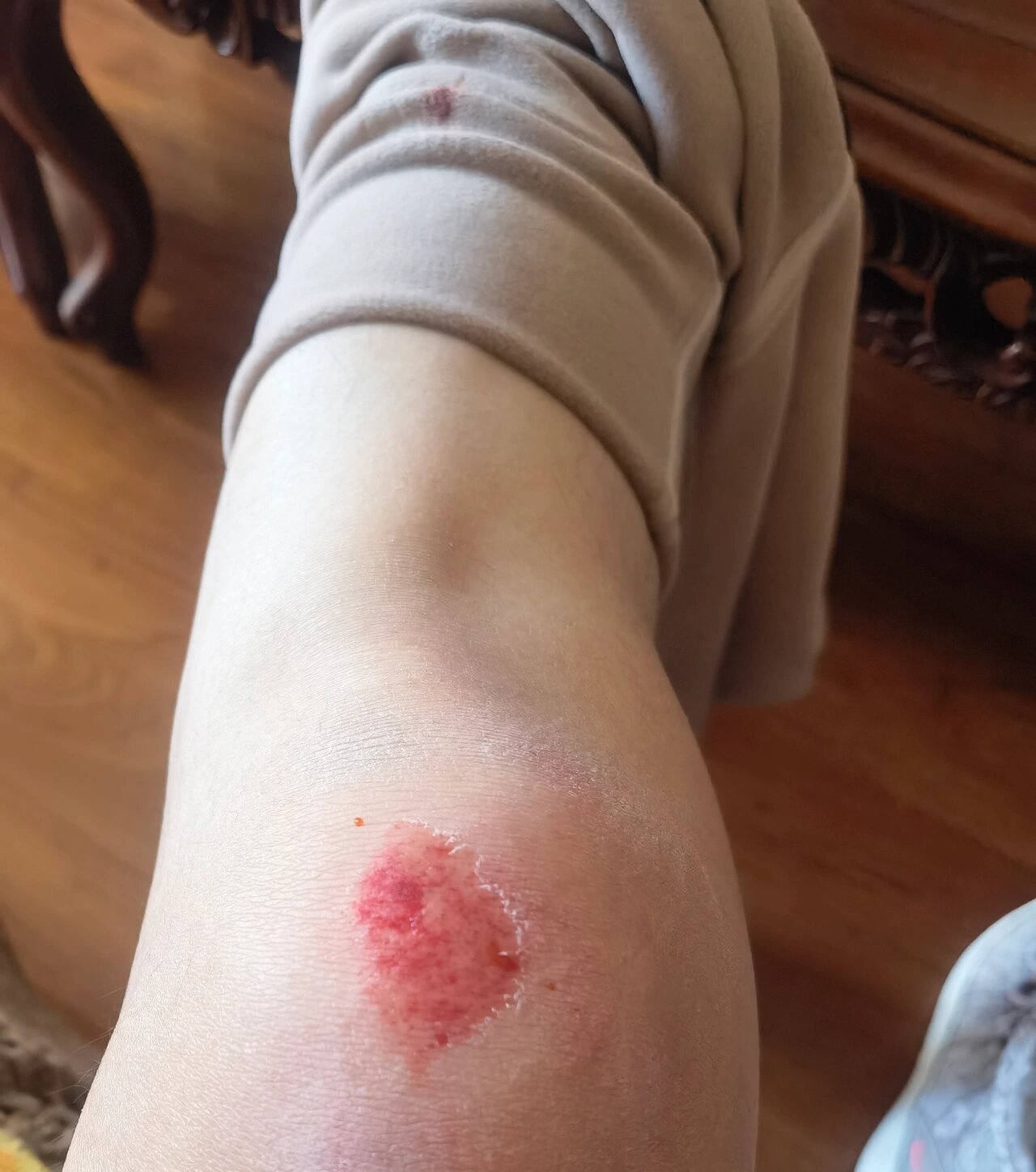 膝盖的伤口不易好怎么办?