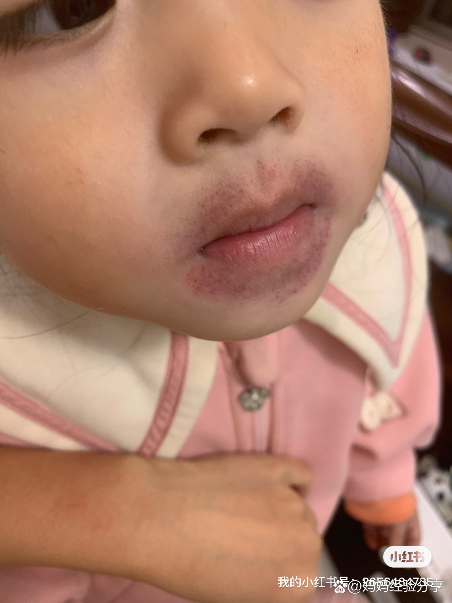 小孩嘴巴周围起红点点